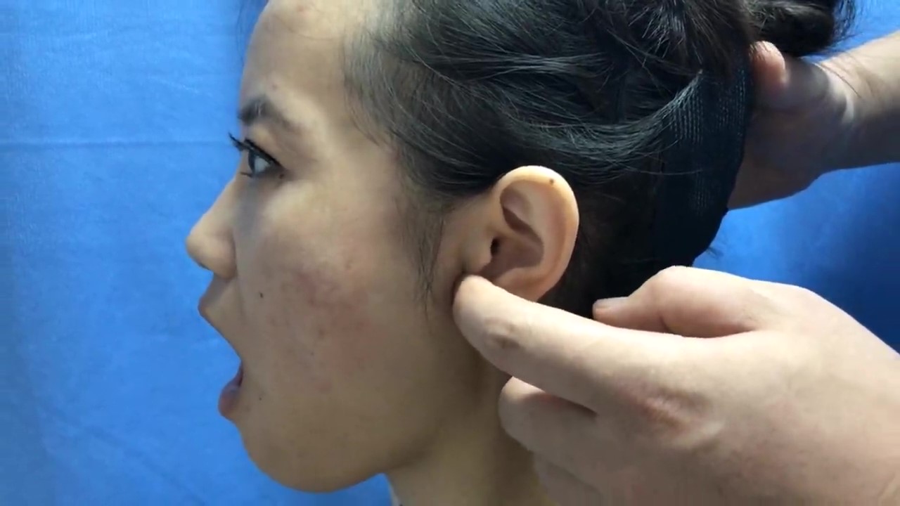 听会穴